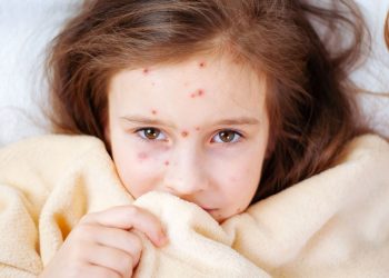 cara mengobati cacar air pada anak kecil