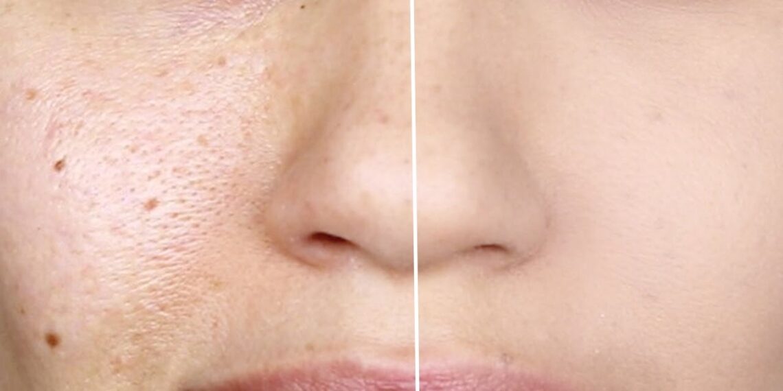 Mengecilkan Pori-pori Wajah Secara Alami