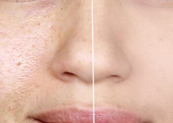 Mengecilkan Pori-pori Wajah Secara Alami